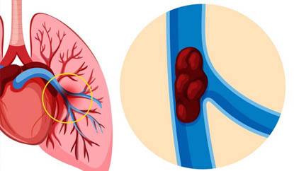 Best Pulmonary Embolism Treatment and Surgery in Meerut